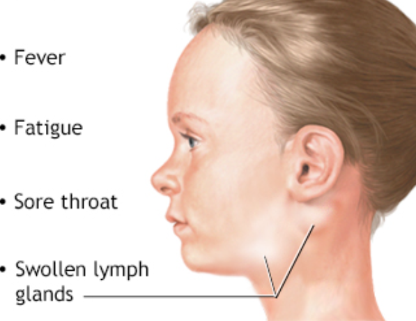 Enlarged Lymph Glands in Children